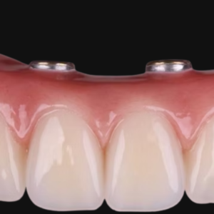 custom screw retained implant crown for dental implant restoration
