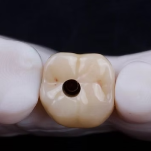 custom screw retained implant crown dental implant restoration
