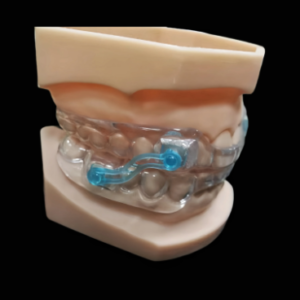 custom occlusal splint for bruxism protection and bite adjustment