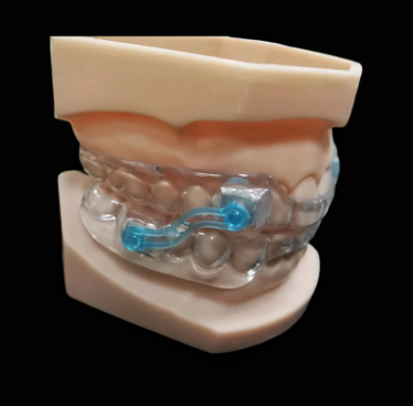 custom occlusal splint for bruxism protection and bite adjustment