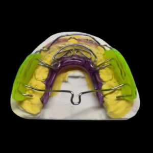 custom removable orthodontic appliance with acrylic base and orthodontic wire components