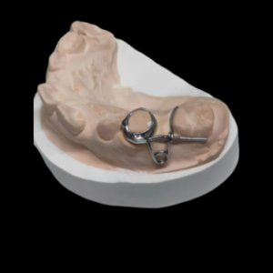 custom removable orthodontic appliance manufactured by HeZhan Dental Lab