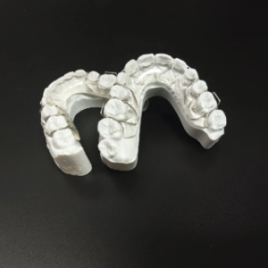 custom Hawley retainer removable orthodontic retention appliance