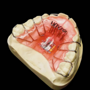 custom orthodontic expansion plate removable dental appliance