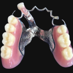 cast metal removable partial denture with pink acrylic saddles and artificial teeth