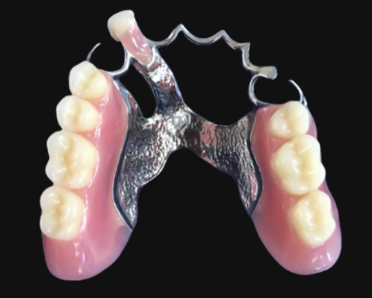 cast metal removable partial denture with pink acrylic saddles and artificial teeth