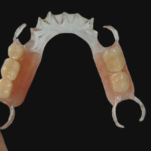 custom PEEK partial denture framework with metal-free dental prosthesis design