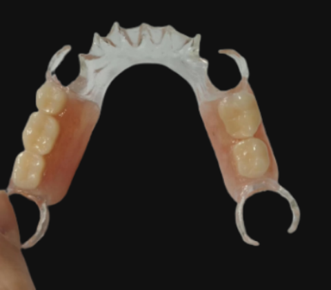 custom PEEK partial denture framework with metal-free dental prosthesis design