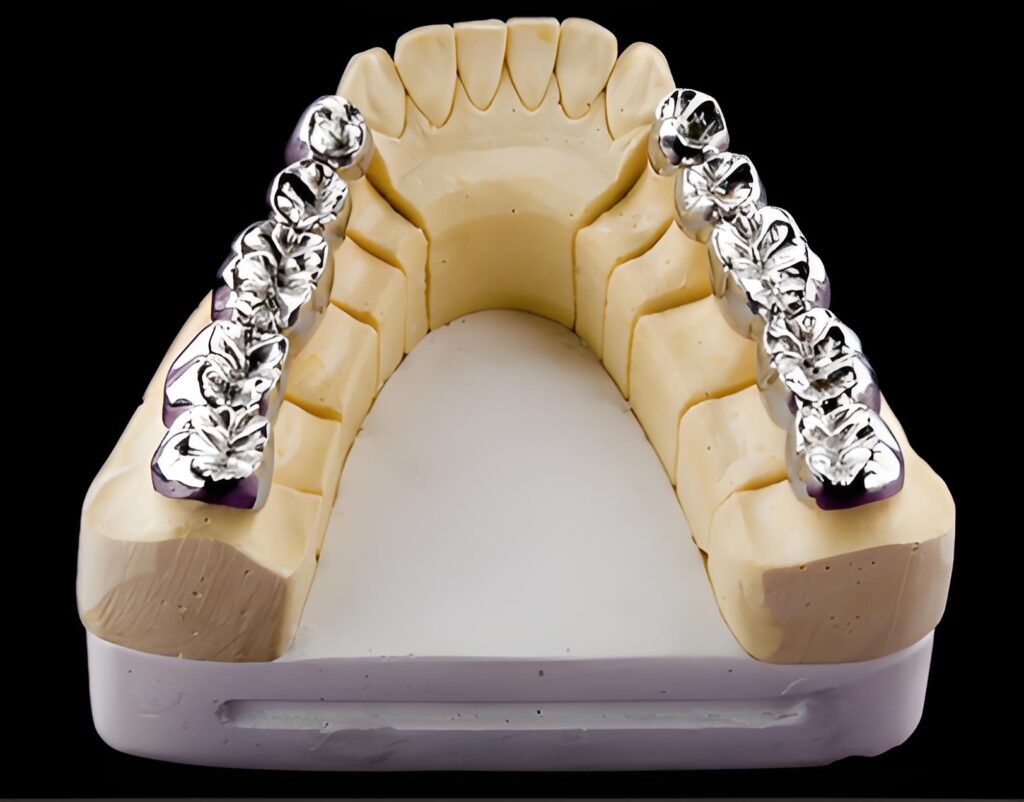 custom full metal crown dental restoration for posterior teeth