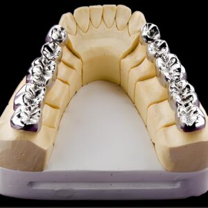 custom full metal crown dental restoration for posterior teeth