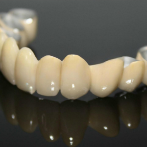 custom dental bridge restoration with natural tooth appearance