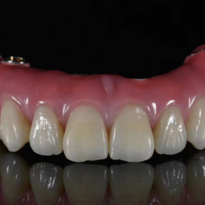 custom implant-supported dental crown restoration for implant rehabilitation