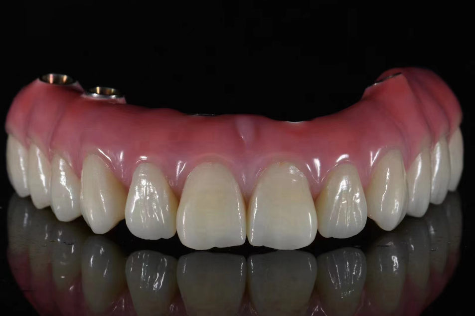 custom implant-supported dental crown restoration for implant rehabilitation