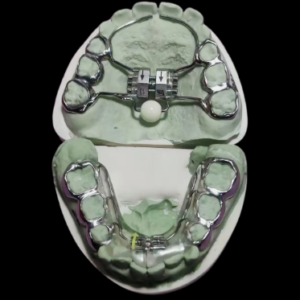 custom rapid palatal expander appliance with expansion screw for orthodontic maxillary expansion