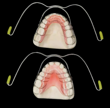 custom orthodontic facebow extraoral dental appliance
