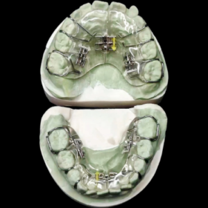 custom removable orthodontic expansion appliance for orthodontic treatment