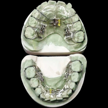 custom removable orthodontic expansion appliance for orthodontic treatment