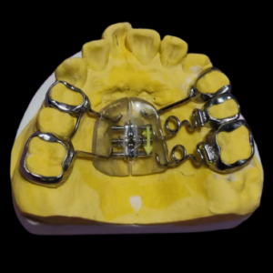 custom hyrax palatal expander appliance with expansion screw for orthodontic treatment
