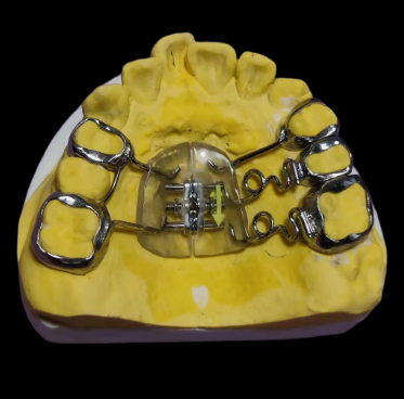 custom hyrax palatal expander appliance with expansion screw for orthodontic treatment