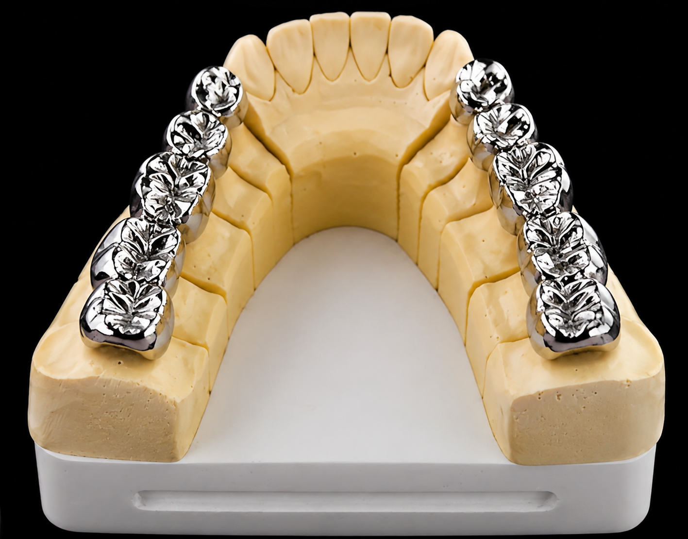 Maxillary dental model featuring precision-fitted metal crowns and dental bridge restorations