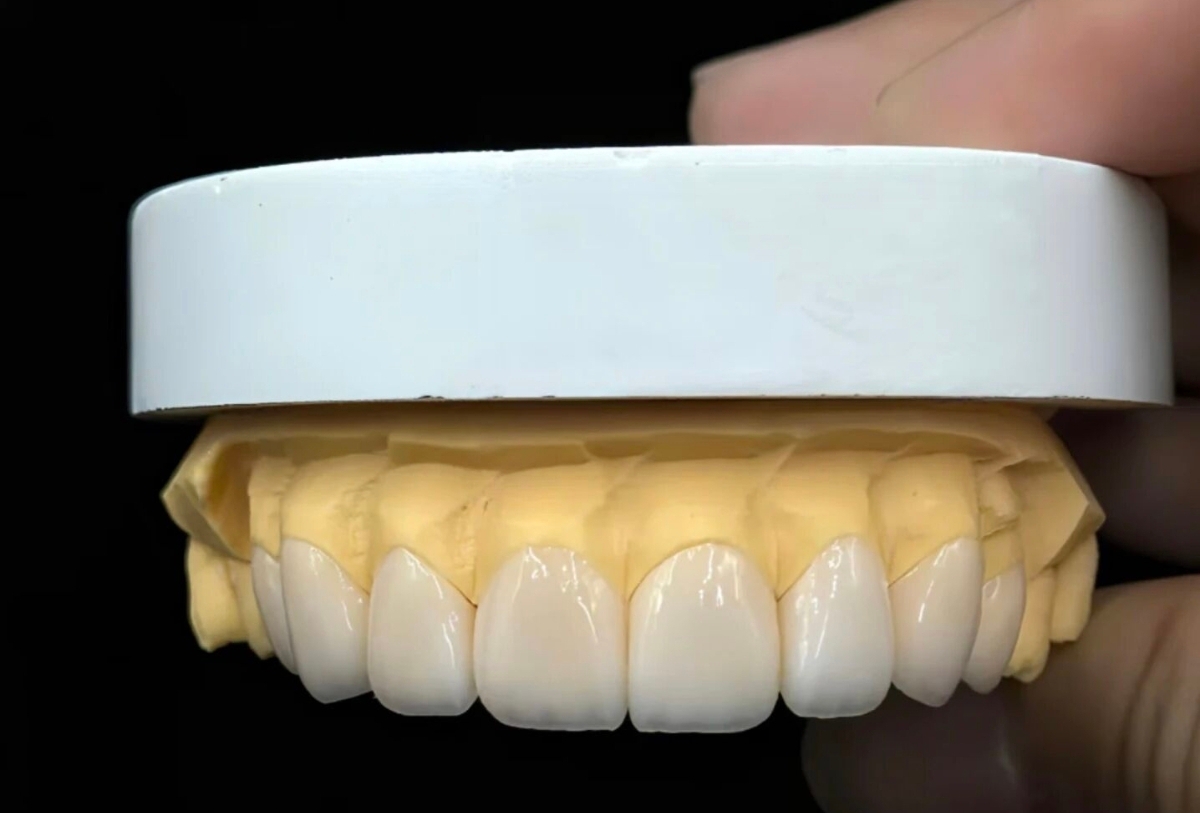 Temporary Dental Bridge for Provisional Crown and Bridge Restoration