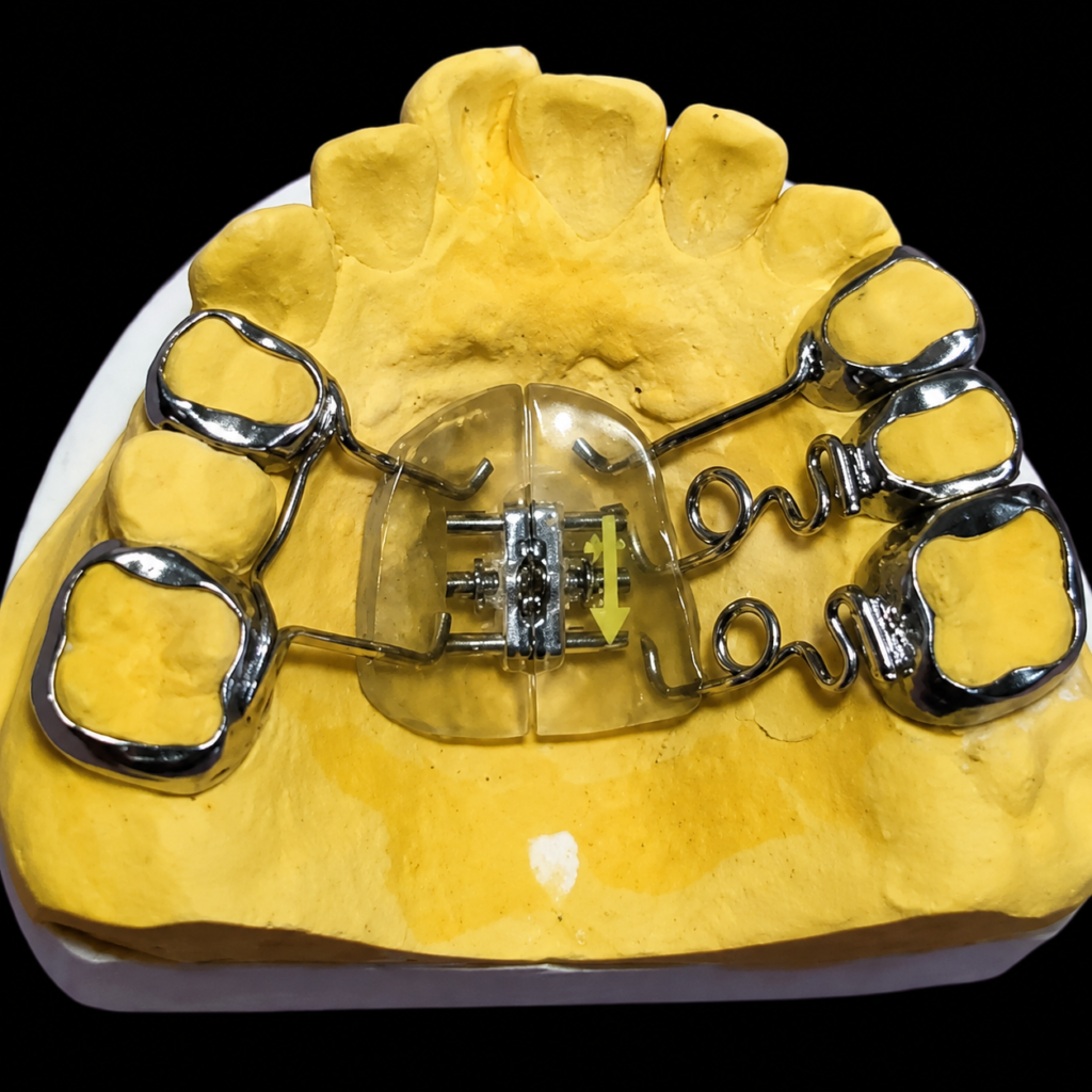 `Custom Fixed Pendulum Expansion Orthodontic Appliance with Hyrax Screw and Molar Bands on Yellow Dental Stone Model`