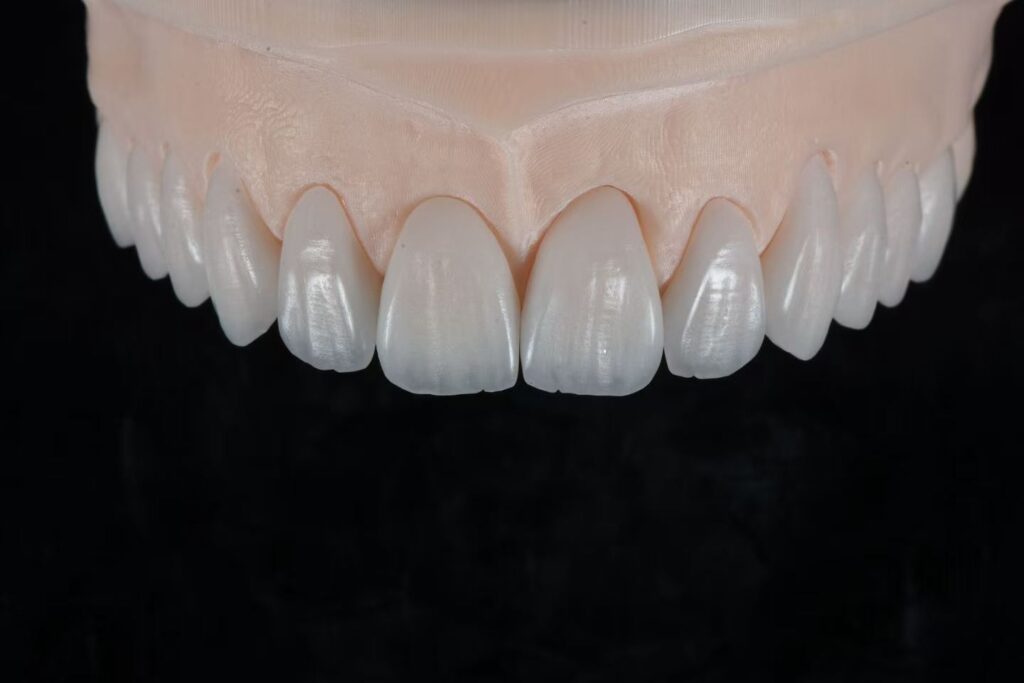 Crown, Bridge, or Implant Restoration