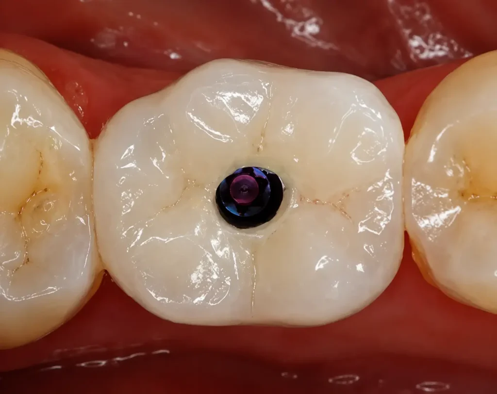 implant zirconia crown with screw access hole on molar tooth in clinical oral view