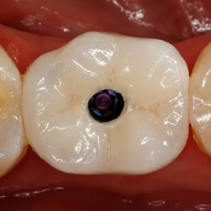 implant zirconia crown with screw access hole on molar tooth in clinical oral view