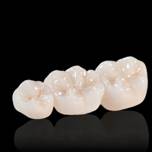 Monolithic zirconia dental bridge restoration for posterior teeth