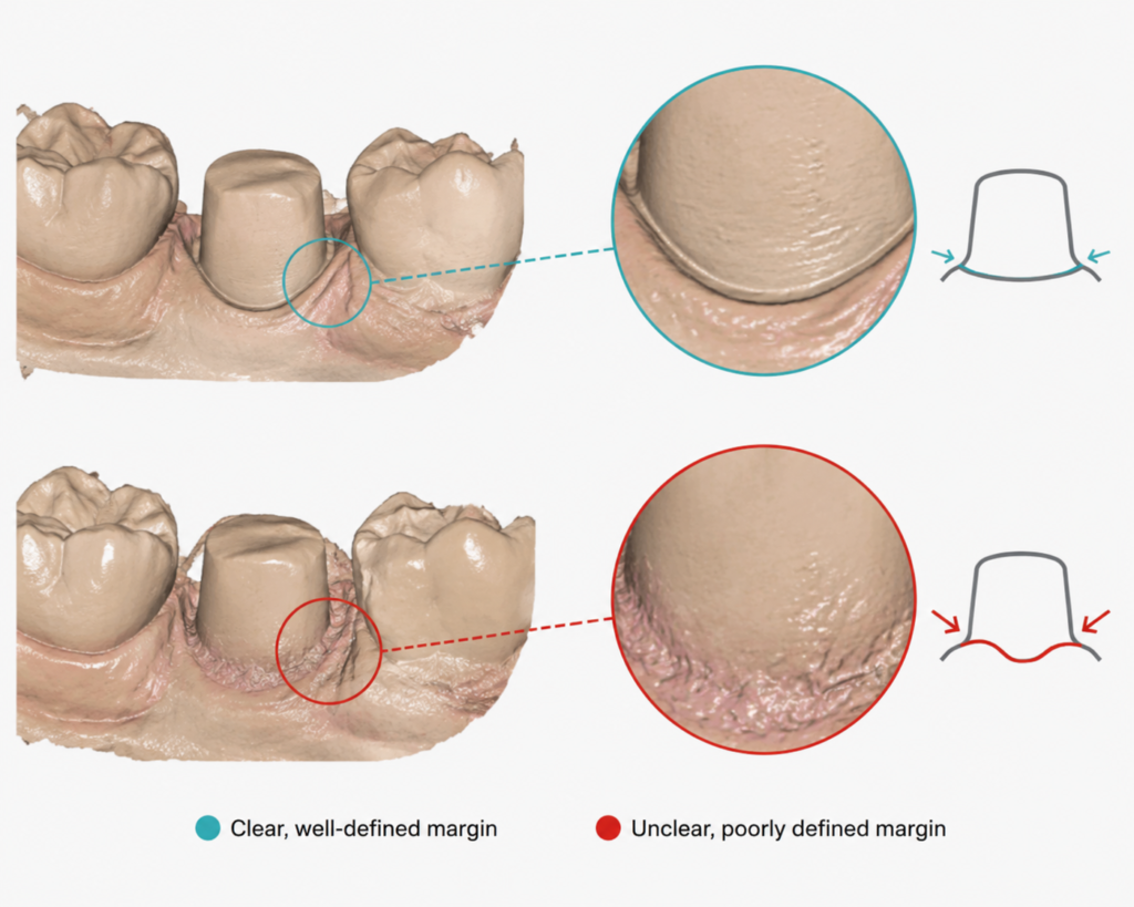 Dental laboratory review of preparation margin visibility from intraoral scan data