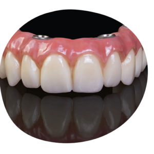 Full arch fixed implant denture, All on 4 zirconia dental bridge with custom pink gum porcelain, dental lab prosthesis