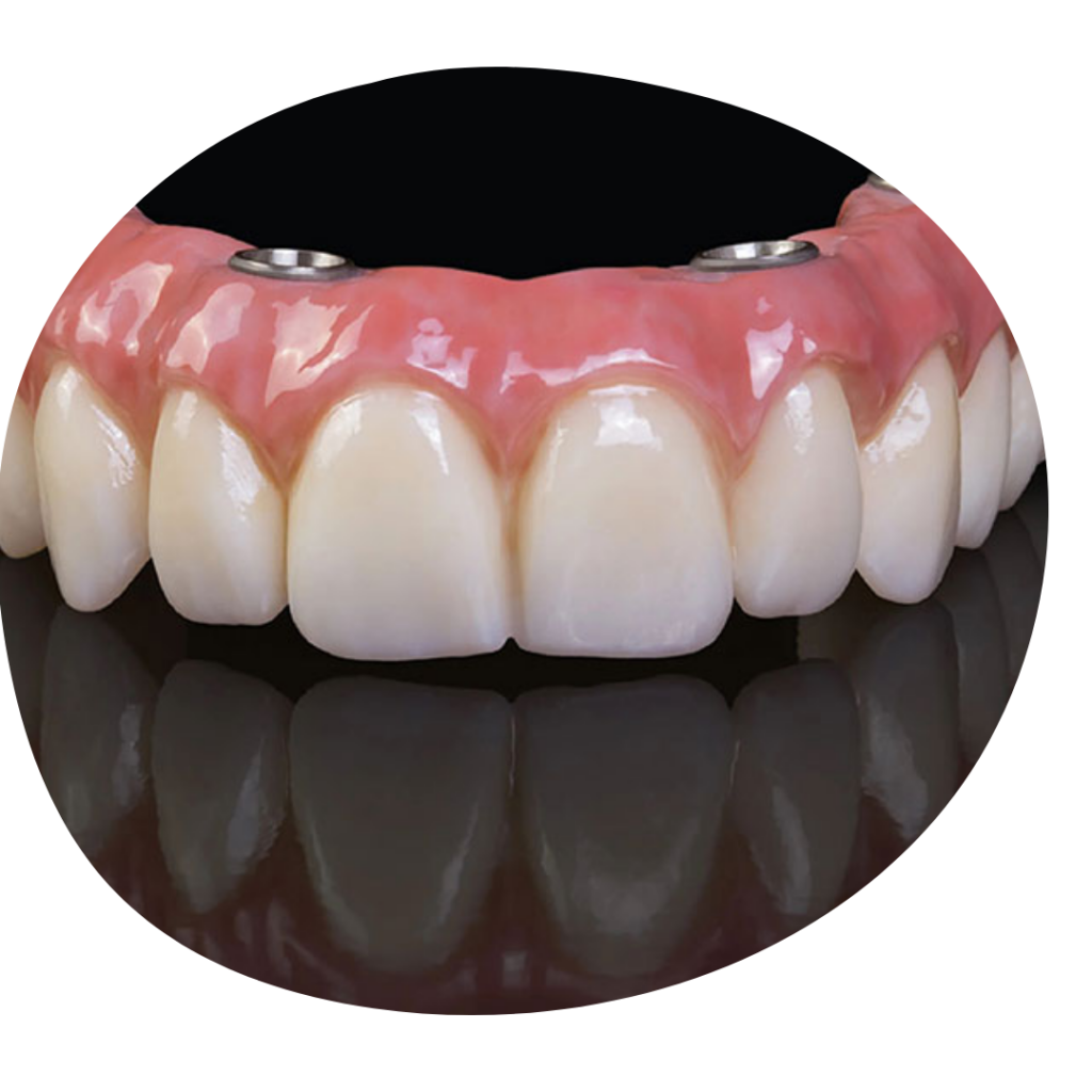 Full arch fixed implant denture, All on 4 zirconia dental bridge with custom pink gum porcelain, dental lab prosthesis