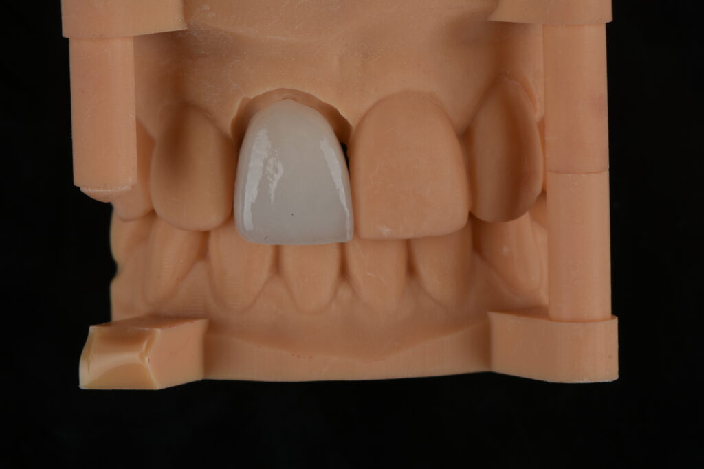 Anterior Zirconia Crown Restoration on Dental Model for High Precision Dental Lab