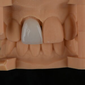 Anterior Zirconia Crown Restoration on Dental Model for High Precision Dental Lab