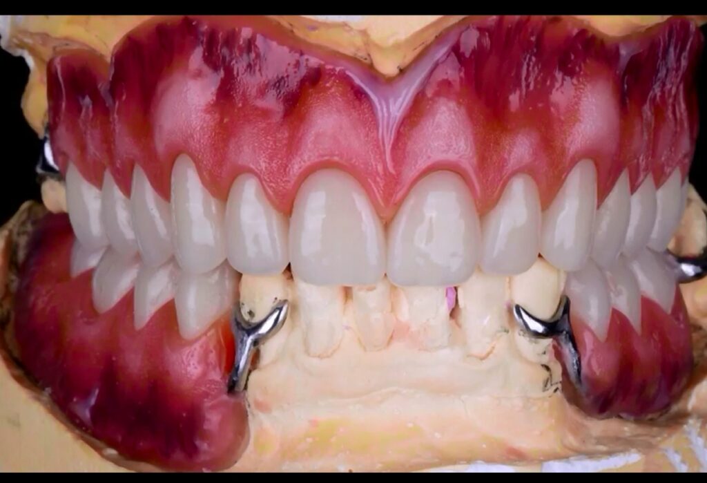 cast metal removable partial denture with pink acrylic saddles and artificial teeth