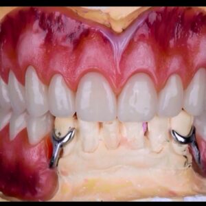 cast metal removable partial denture with pink acrylic saddles and artificial teeth