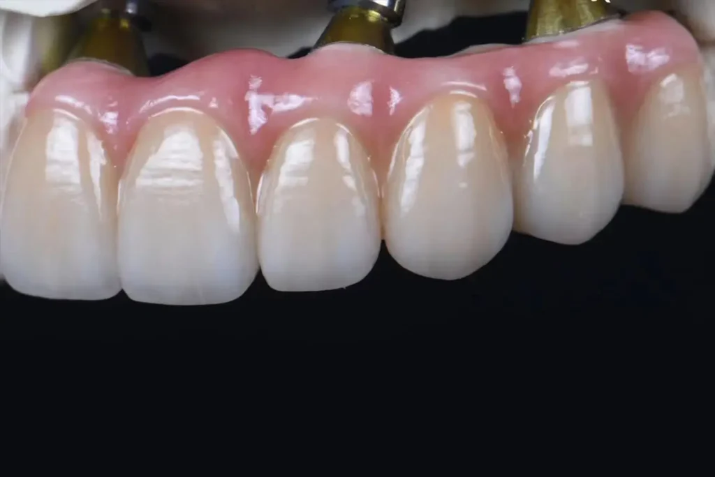 Implant-supported dental restorations and implant crown solutions