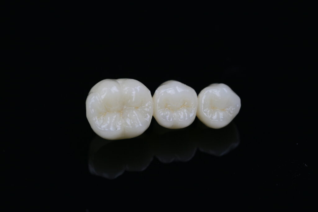 High-translucency full-contour multilayer zirconia dental bridge showing precise occlusal anatomy